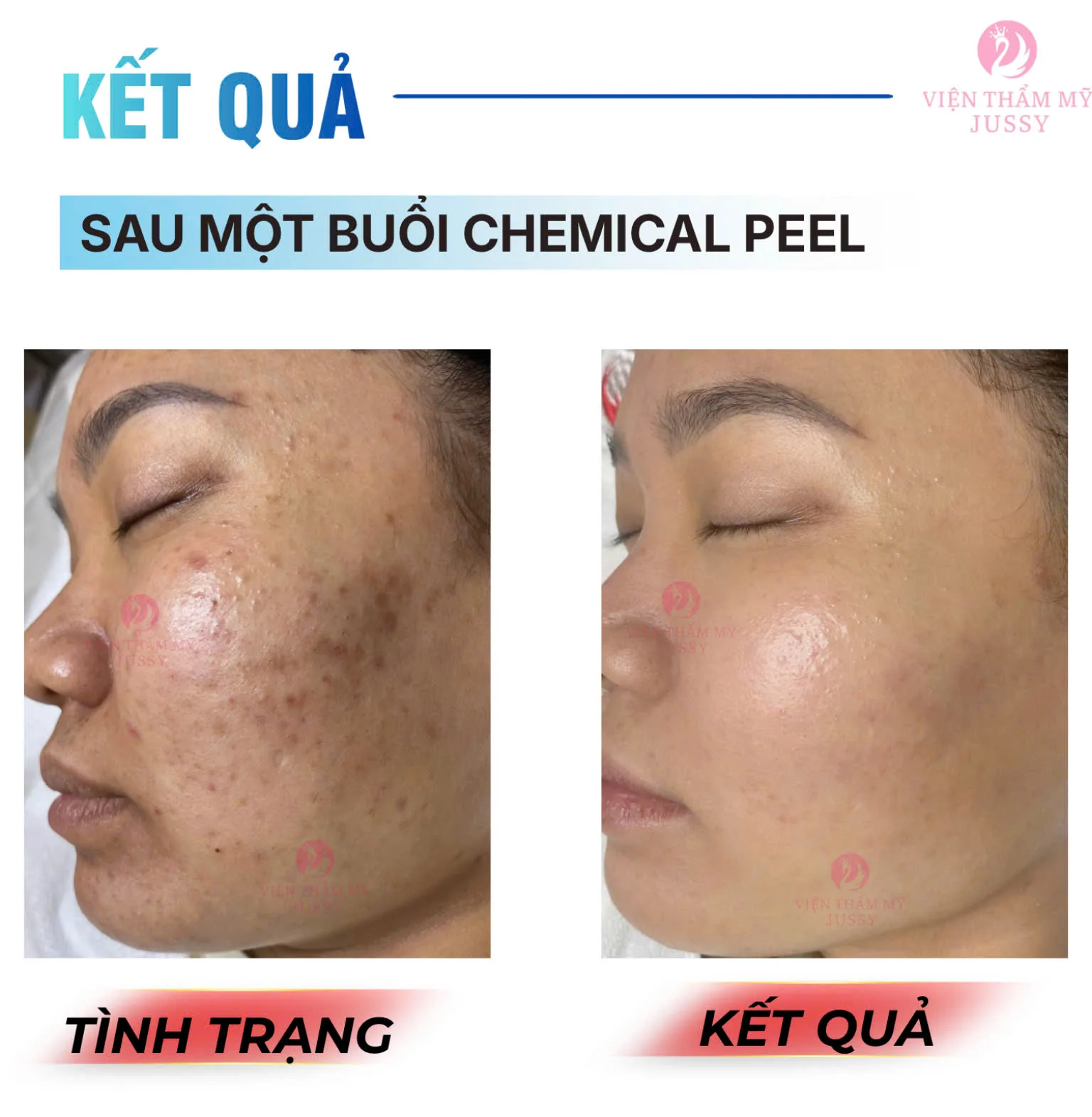 Đặt Lịch Peel Da Chuẩn Y khoa