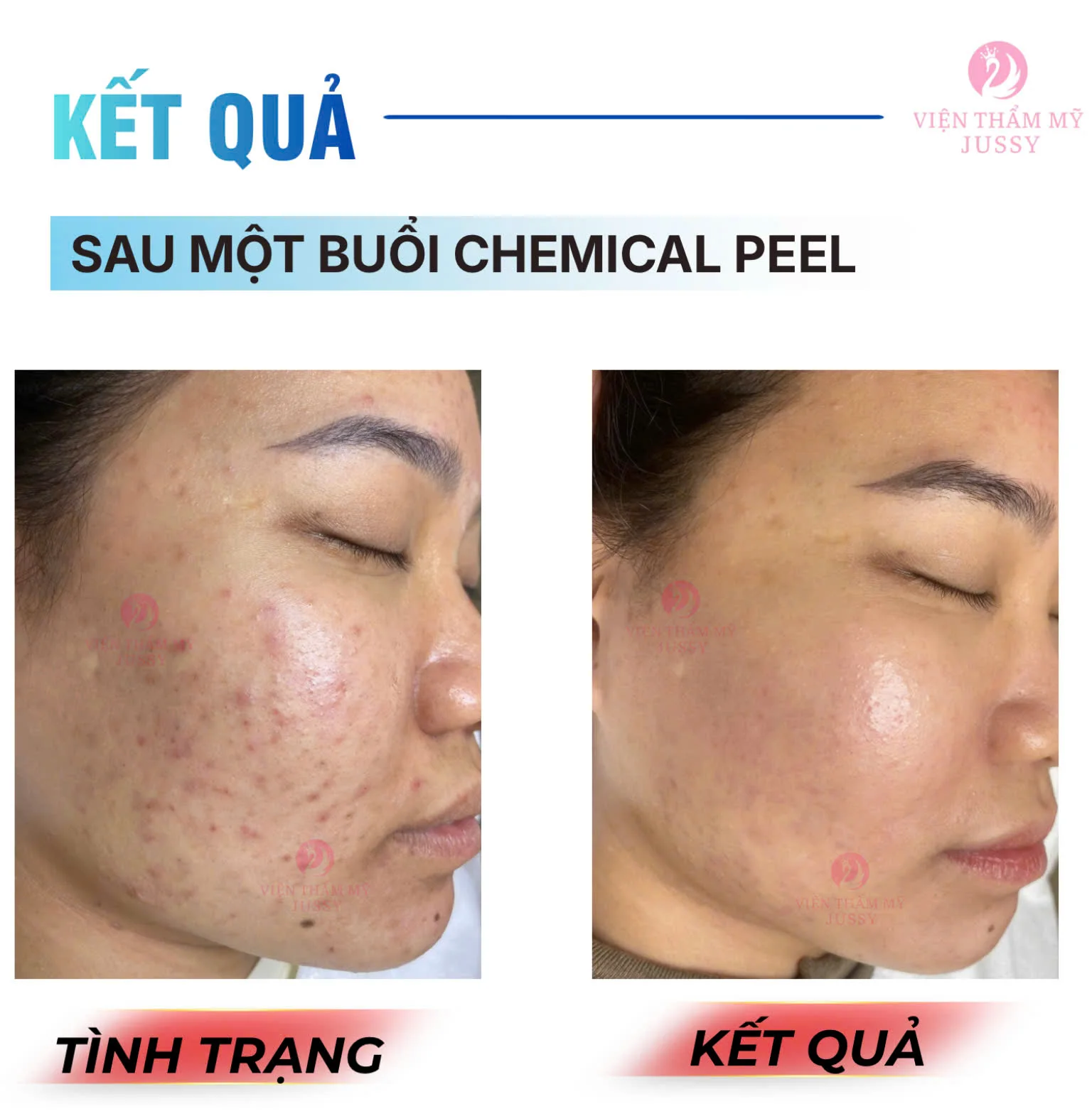 Đặt Lịch Peel Da Chuẩn Y khoa
