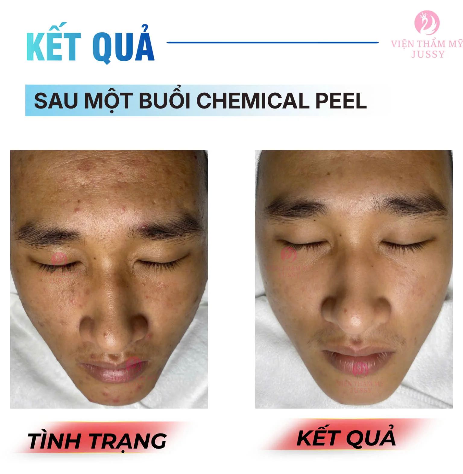 Đặt Lịch Peel Da Chuẩn Y khoa