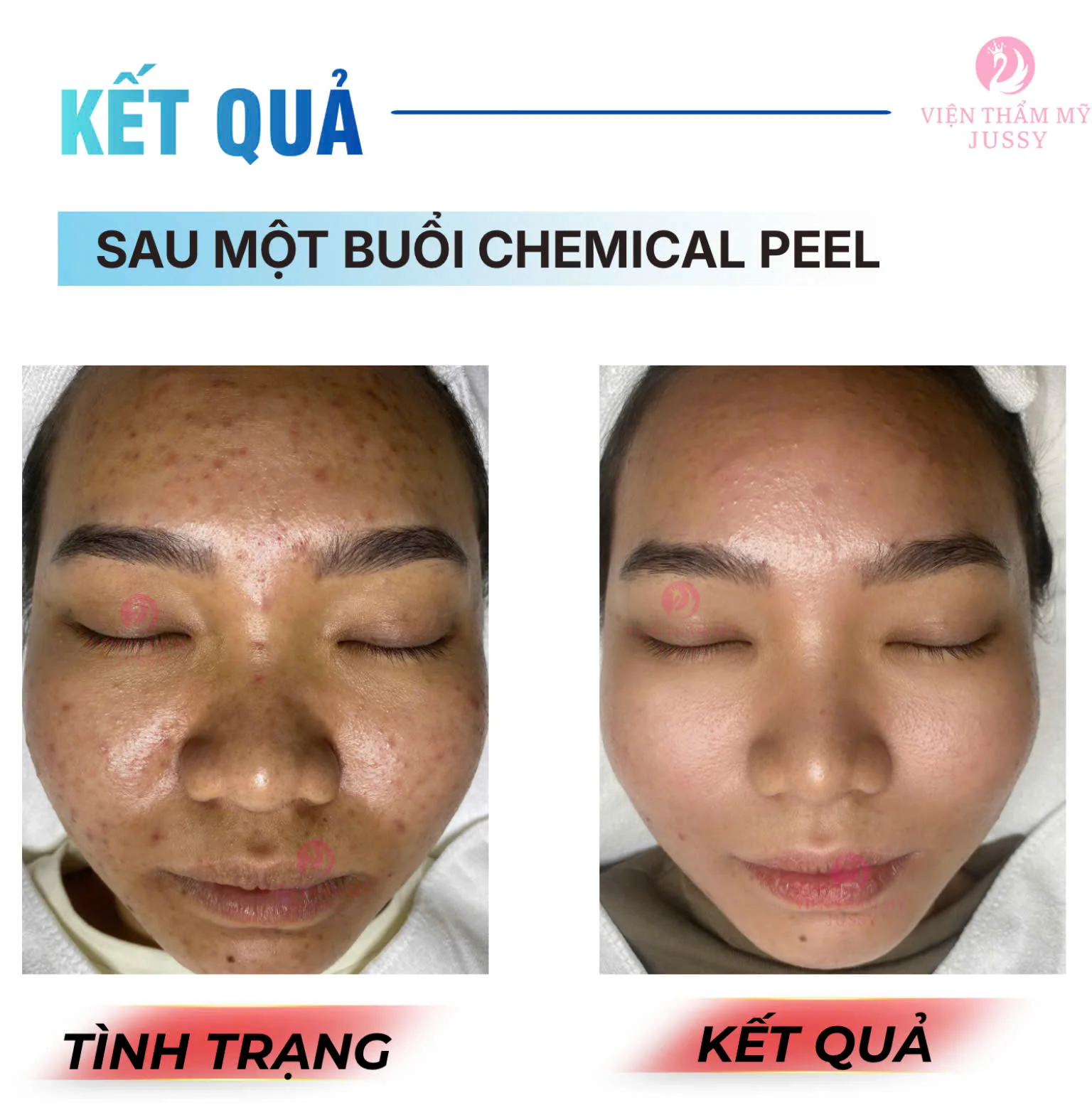 Đặt Lịch Peel Da Chuẩn Y khoa